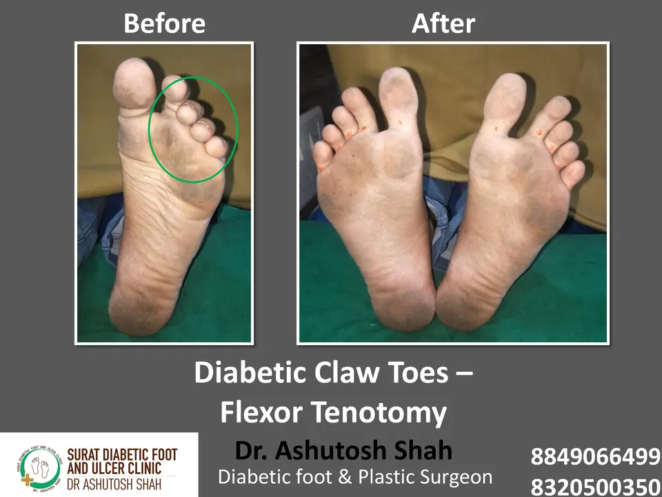 Diabetic Foot  PPT sunita.pptx-22.webp